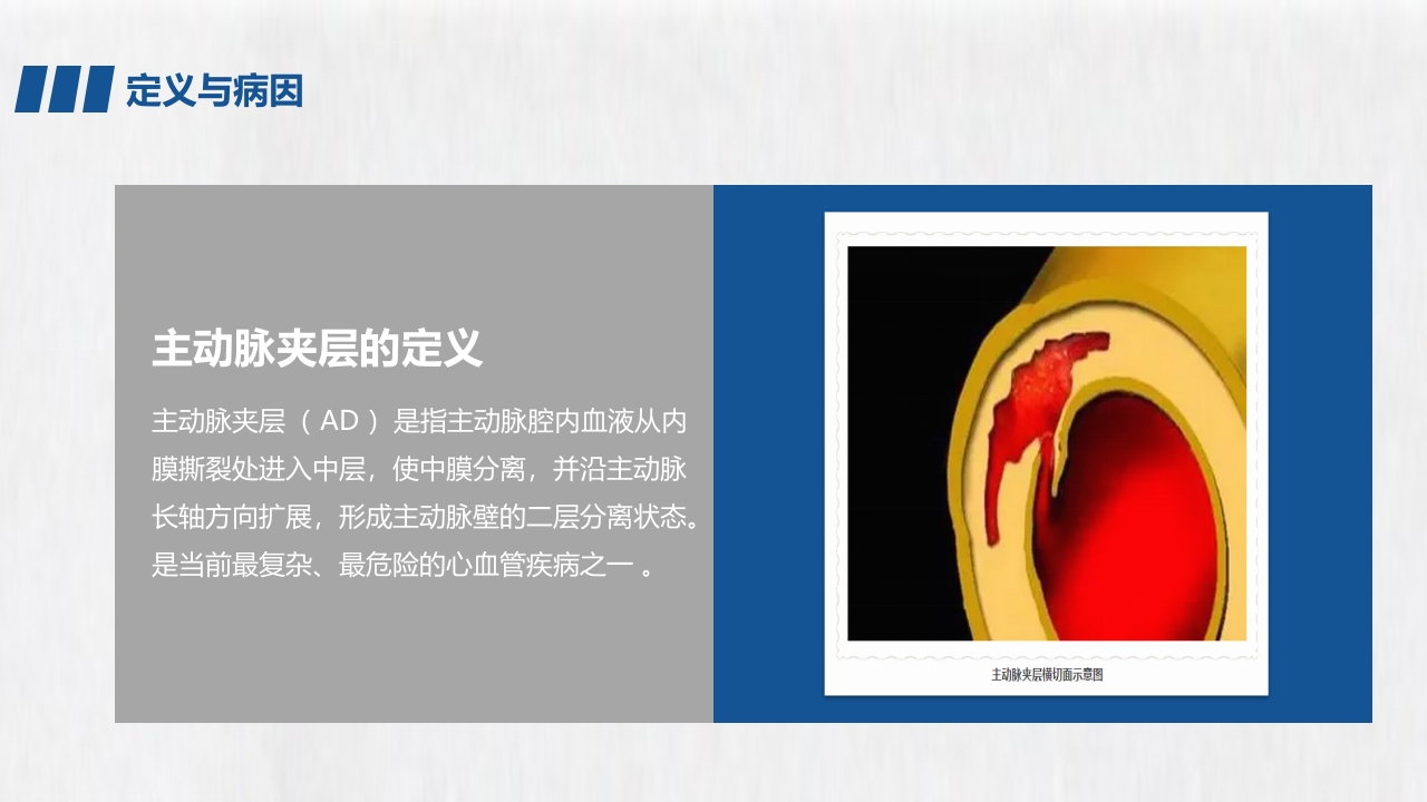 医学医药医疗主动脉夹层PPT课件4
