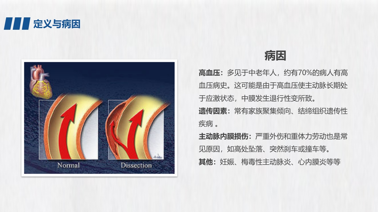 医学医药医疗主动脉夹层PPT课件5