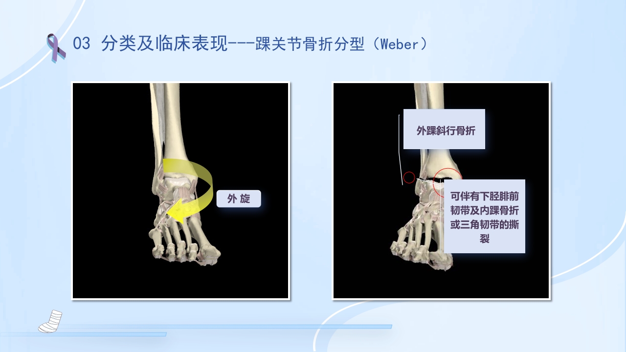 踝关节骨折护理查房护理PPT课件16