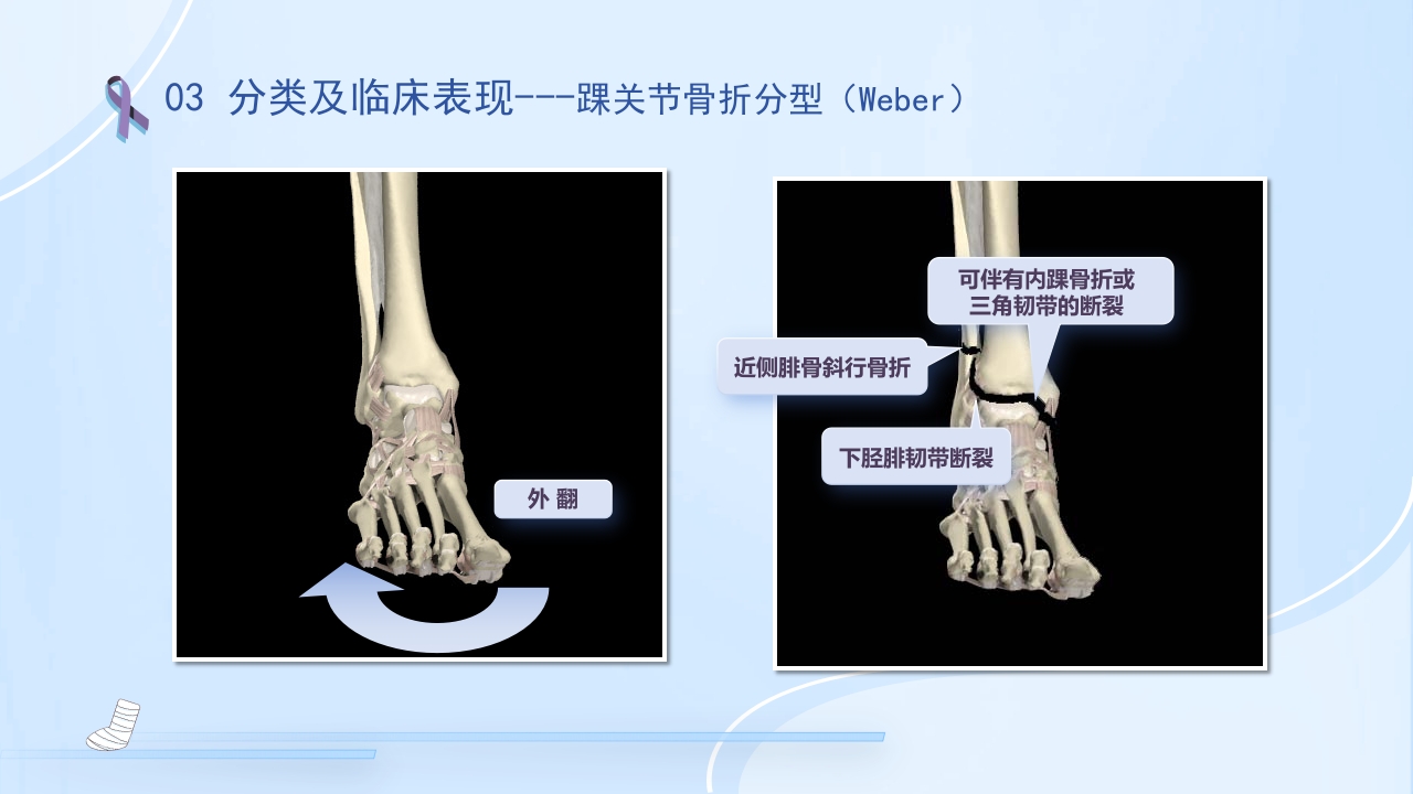 踝关节骨折护理查房护理PPT课件17