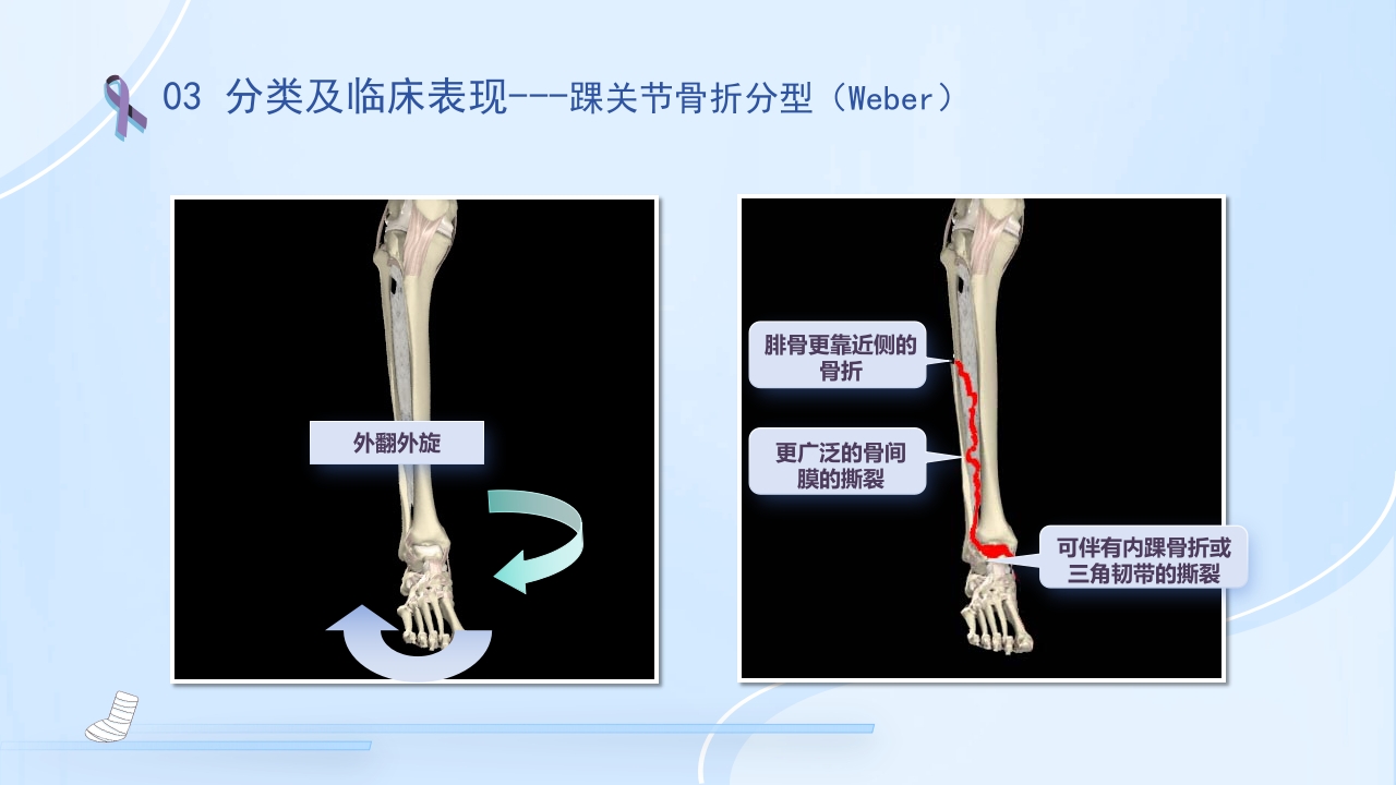 踝关节骨折护理查房护理PPT课件18