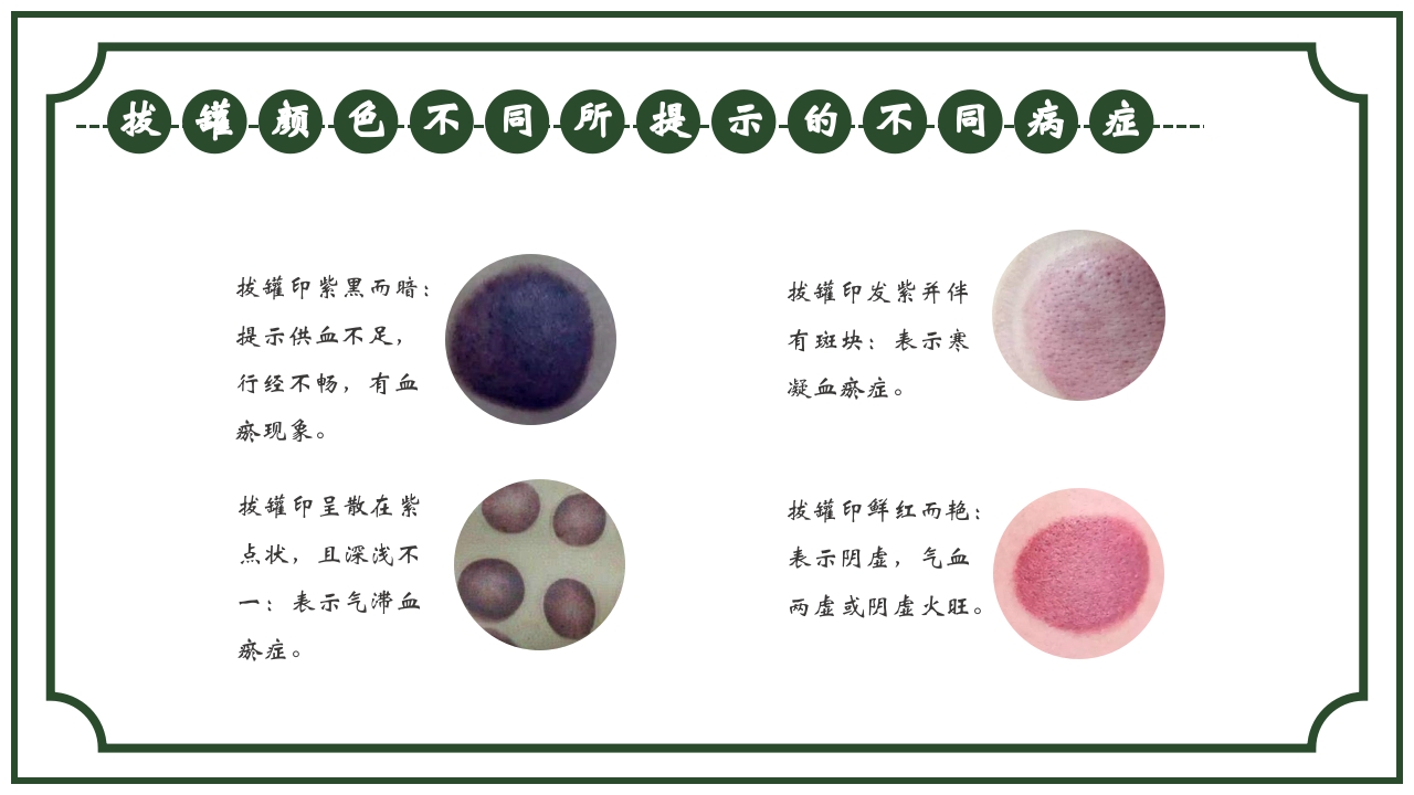 中医护理养生八大操作之一拔罐疗法课件ppt课件20