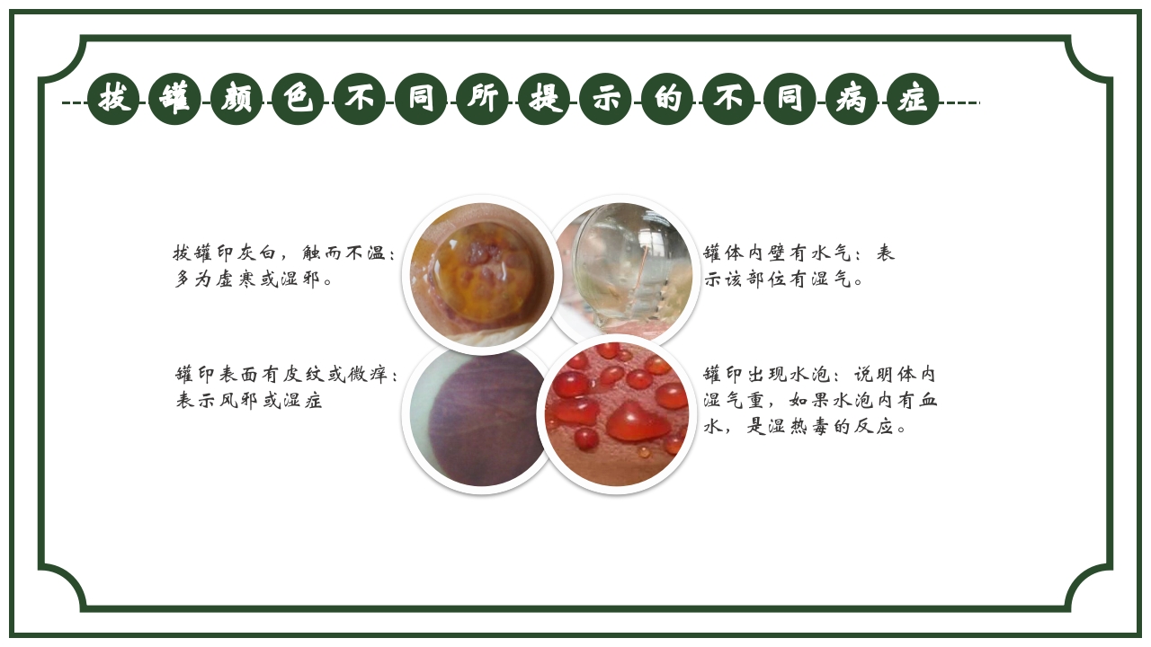 中医护理养生八大操作之一拔罐疗法课件ppt课件21