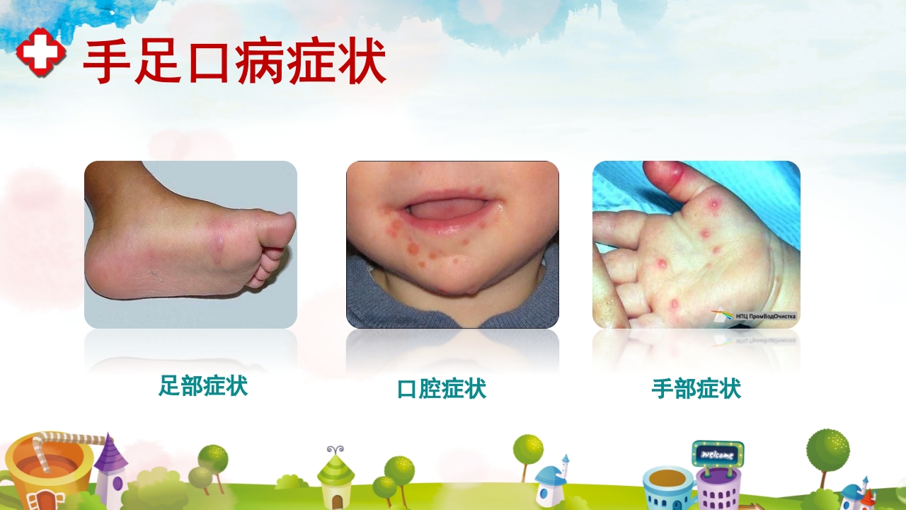 手足口病预防宣传教育PPT课件6