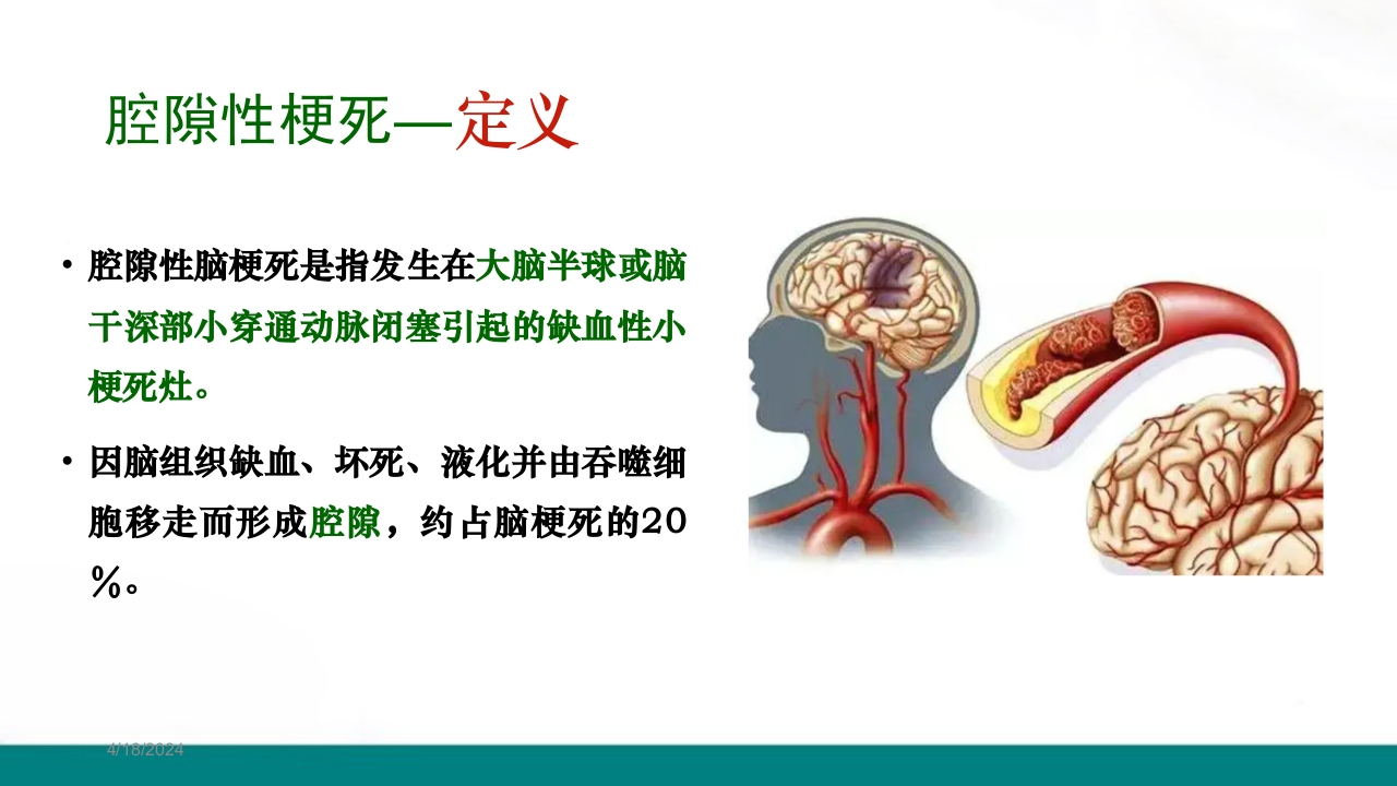 腔隙性脑梗死PPT课件下载2
