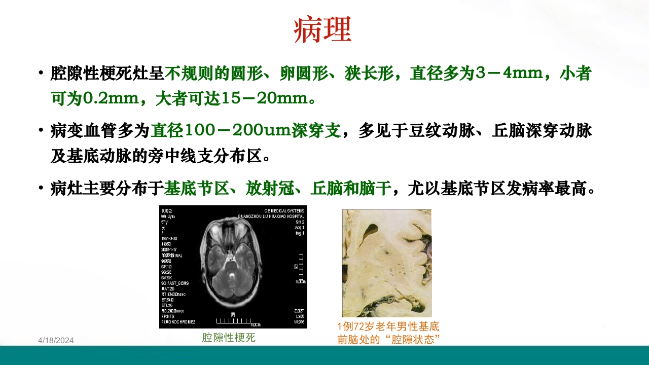 腔隙性脑梗死PPT课件下载9
