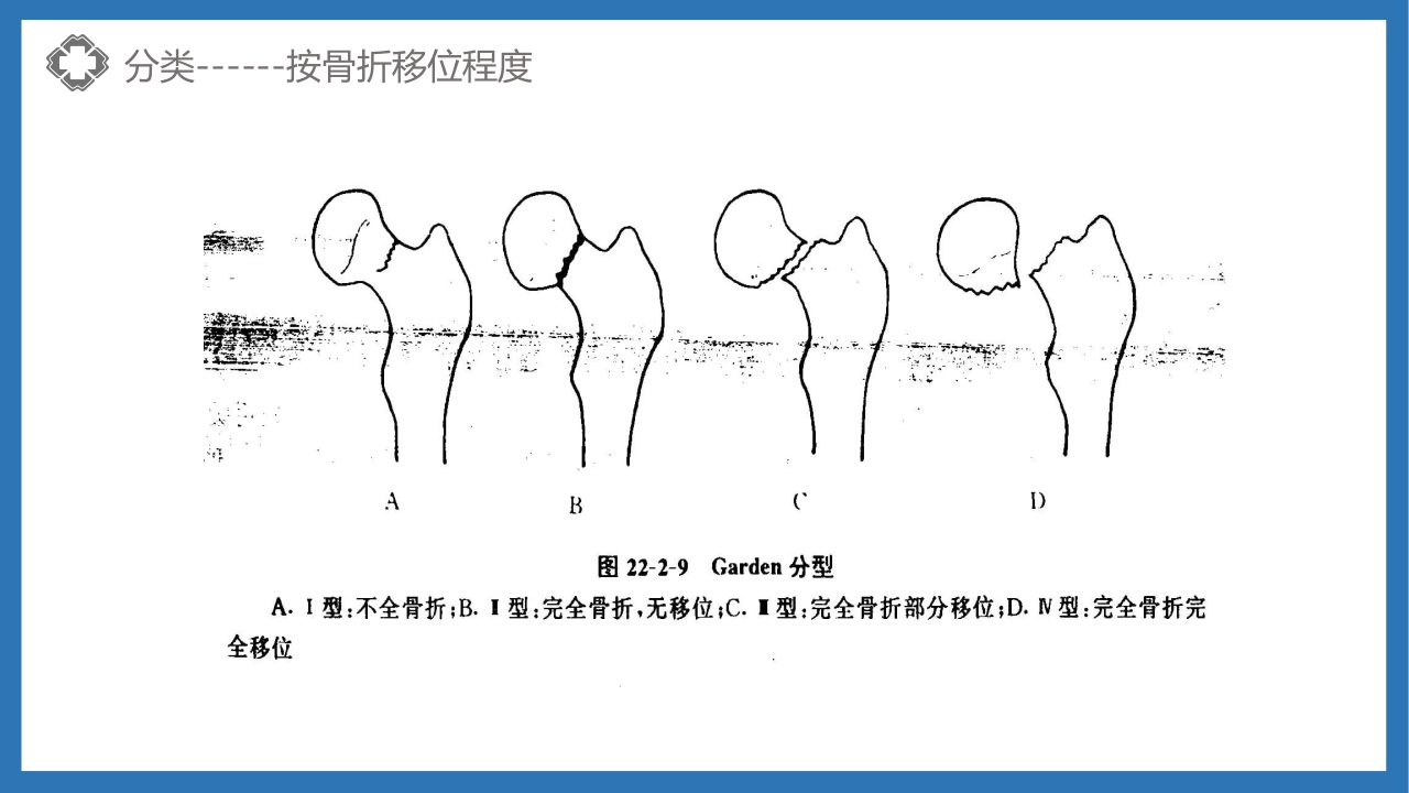 股骨颈骨折护理查房PPT课件16