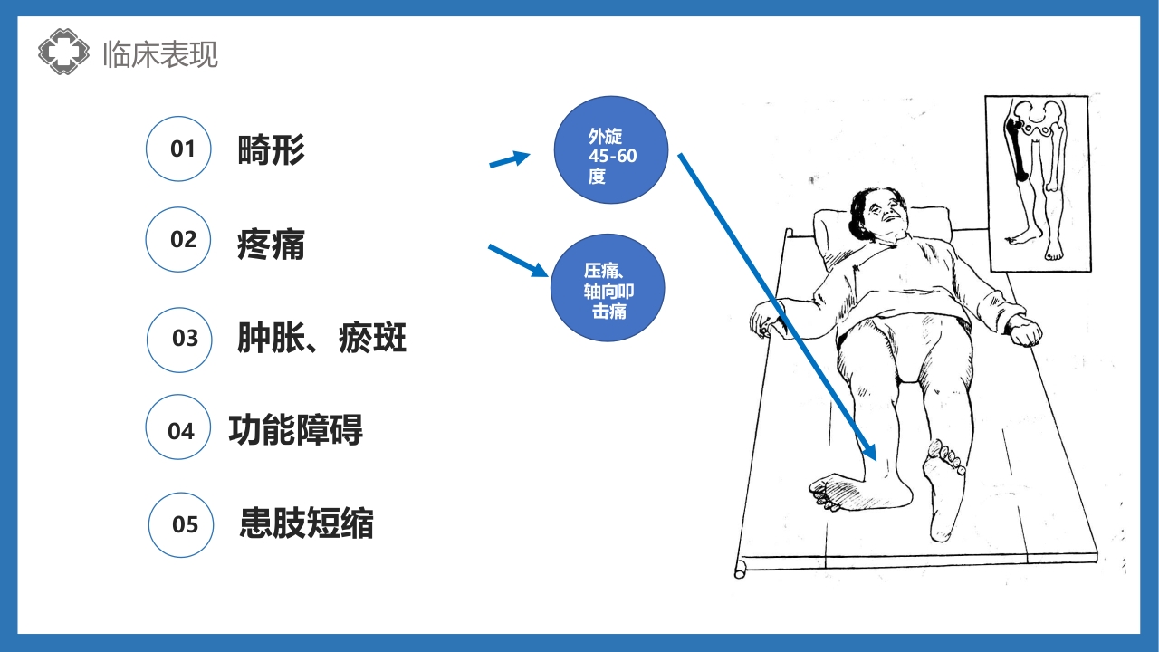 股骨颈骨折护理查房PPT课件17