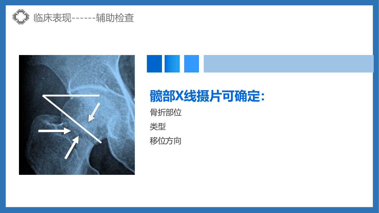 股骨颈骨折护理查房PPT课件18