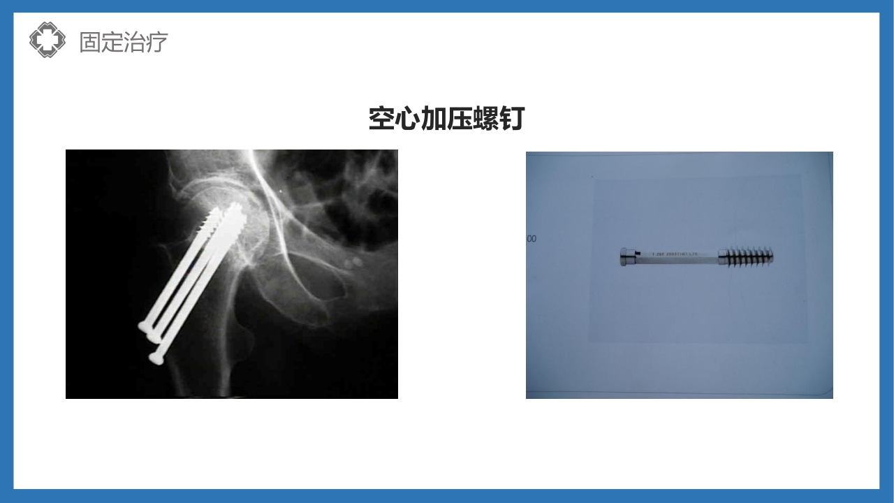 股骨颈骨折护理查房PPT课件24