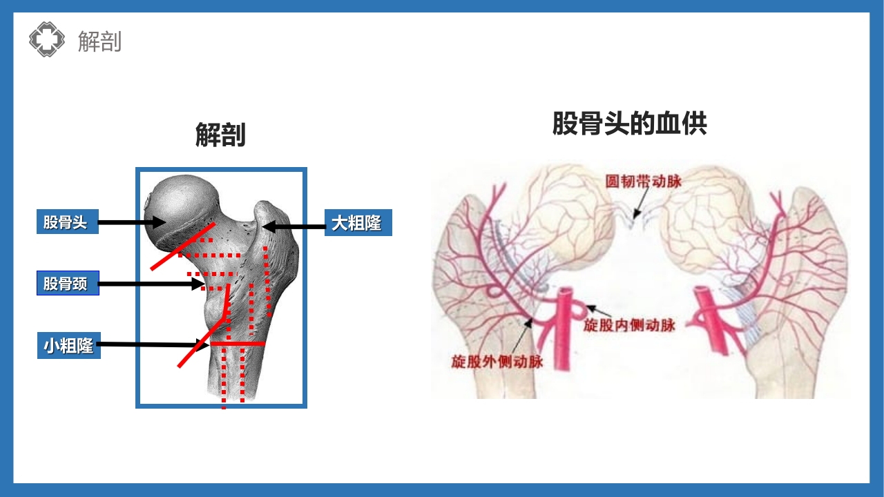 股骨颈骨折护理查房PPT课件9