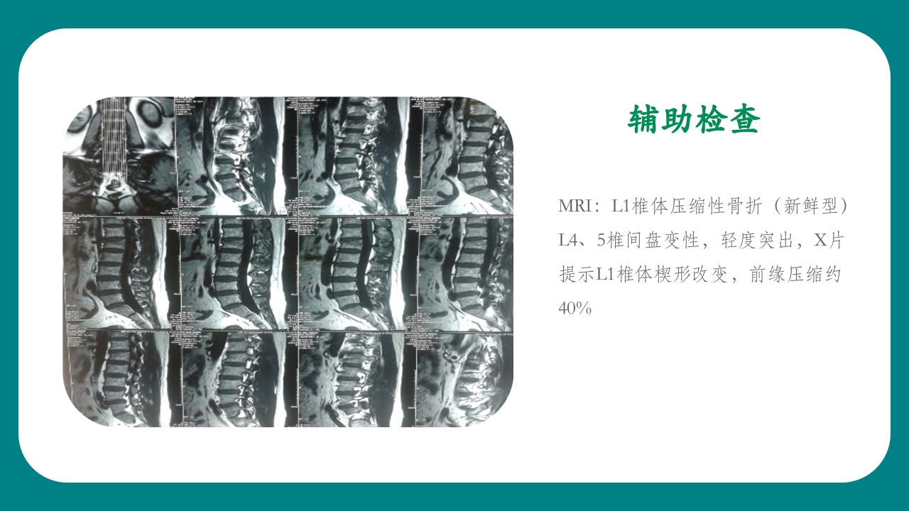腰椎骨科护理查房PPT课件7