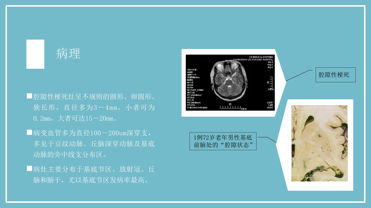 腔隙性脑梗死PPT医药医疗10