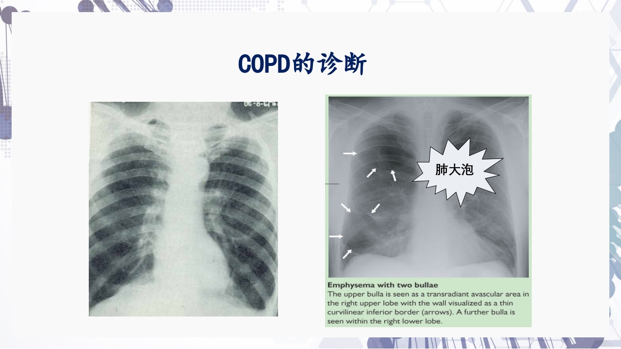 慢性阻塞性肺疾病急性加重（AECOPD）护理查房PPT23