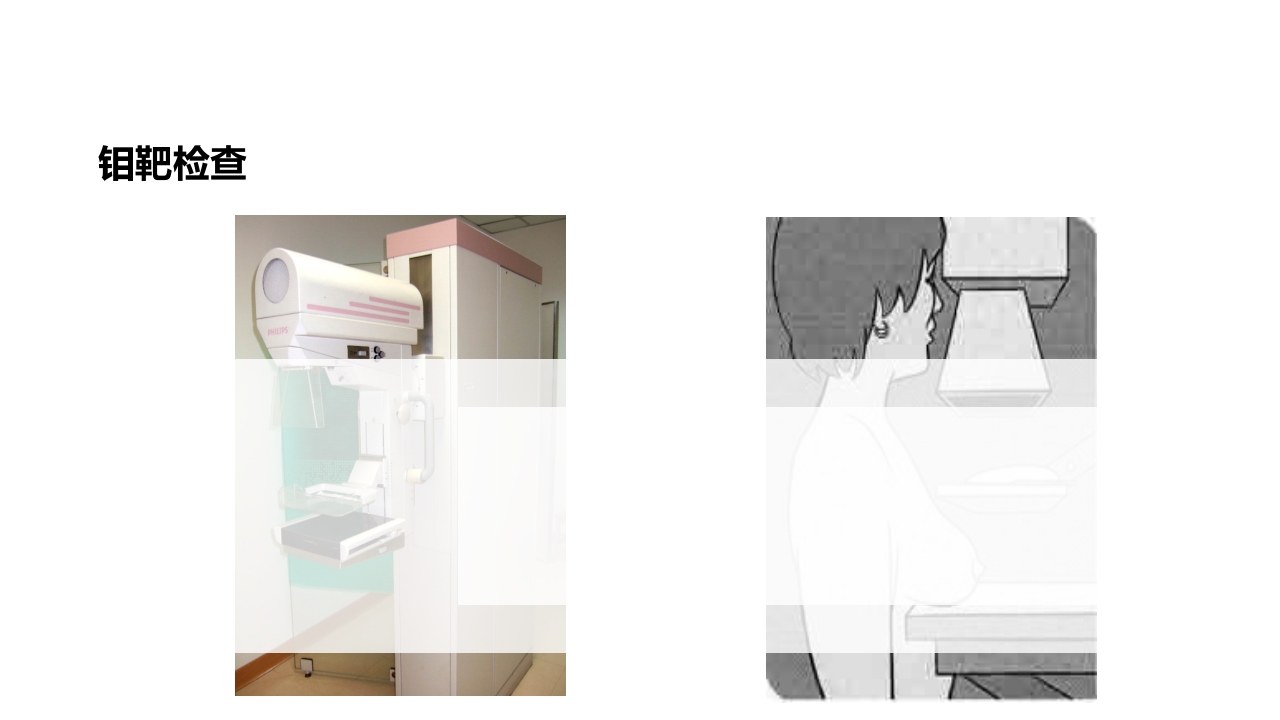 乳腺癌的护理PPT课件下载29