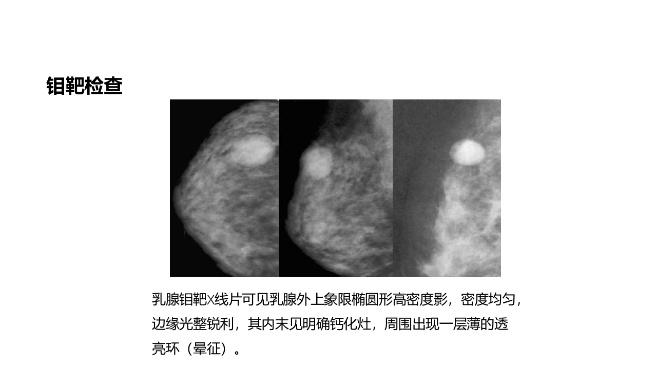 乳腺癌的护理PPT课件下载30