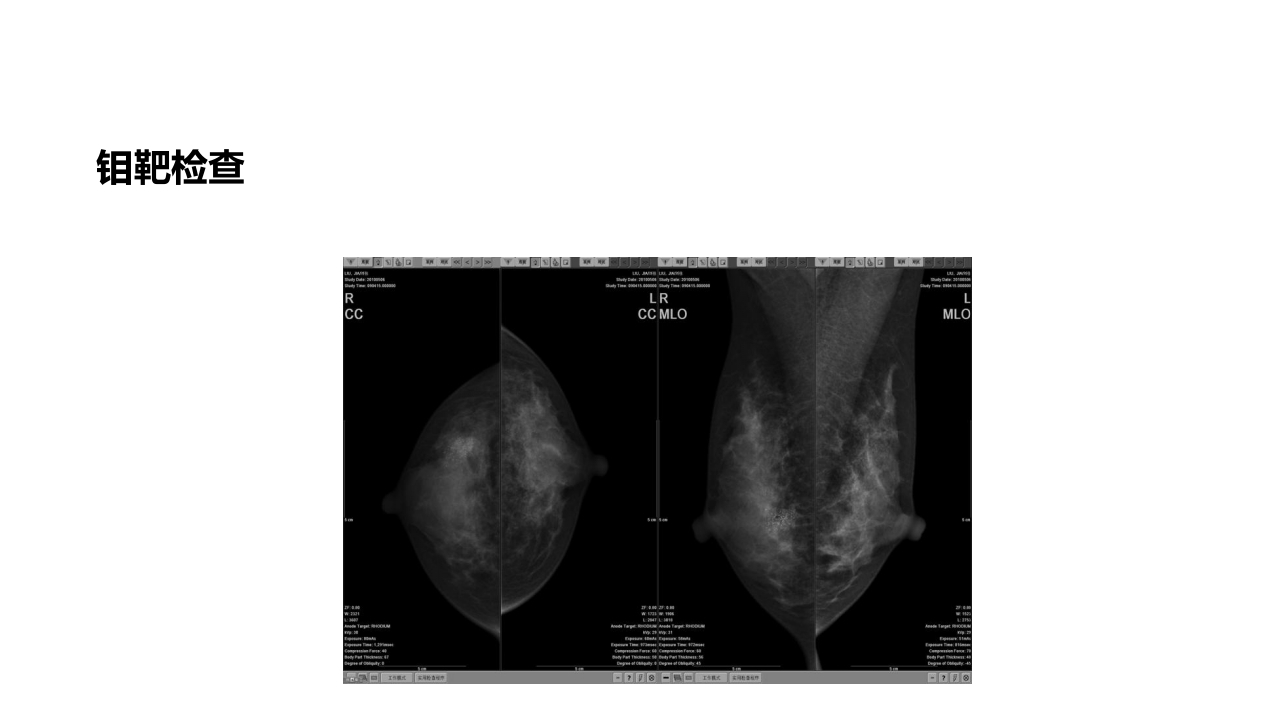 乳腺癌的护理PPT课件下载31