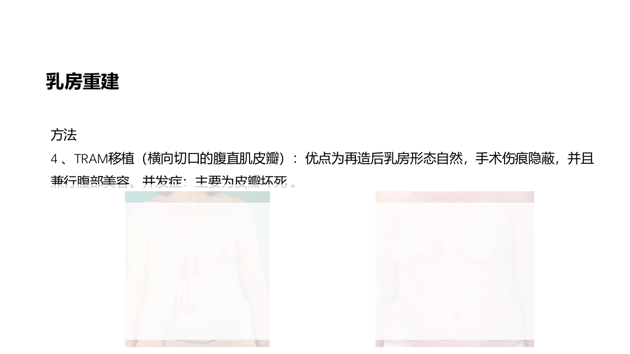 乳腺癌的护理PPT课件下载43