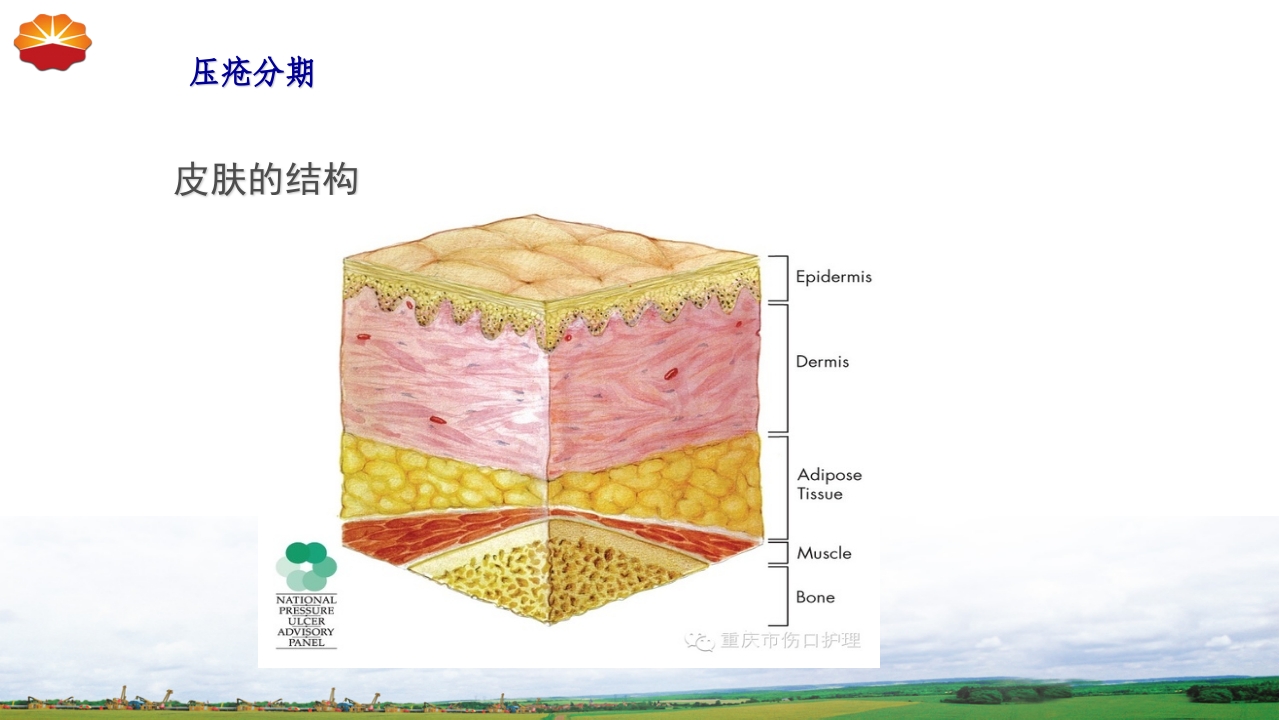 危重患者压疮的治疗及护理13