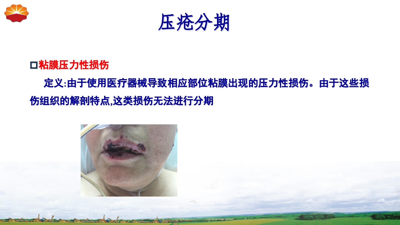 危重患者压疮的治疗及护理16