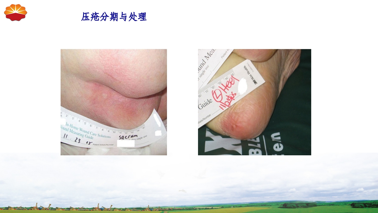 危重患者压疮的治疗及护理19
