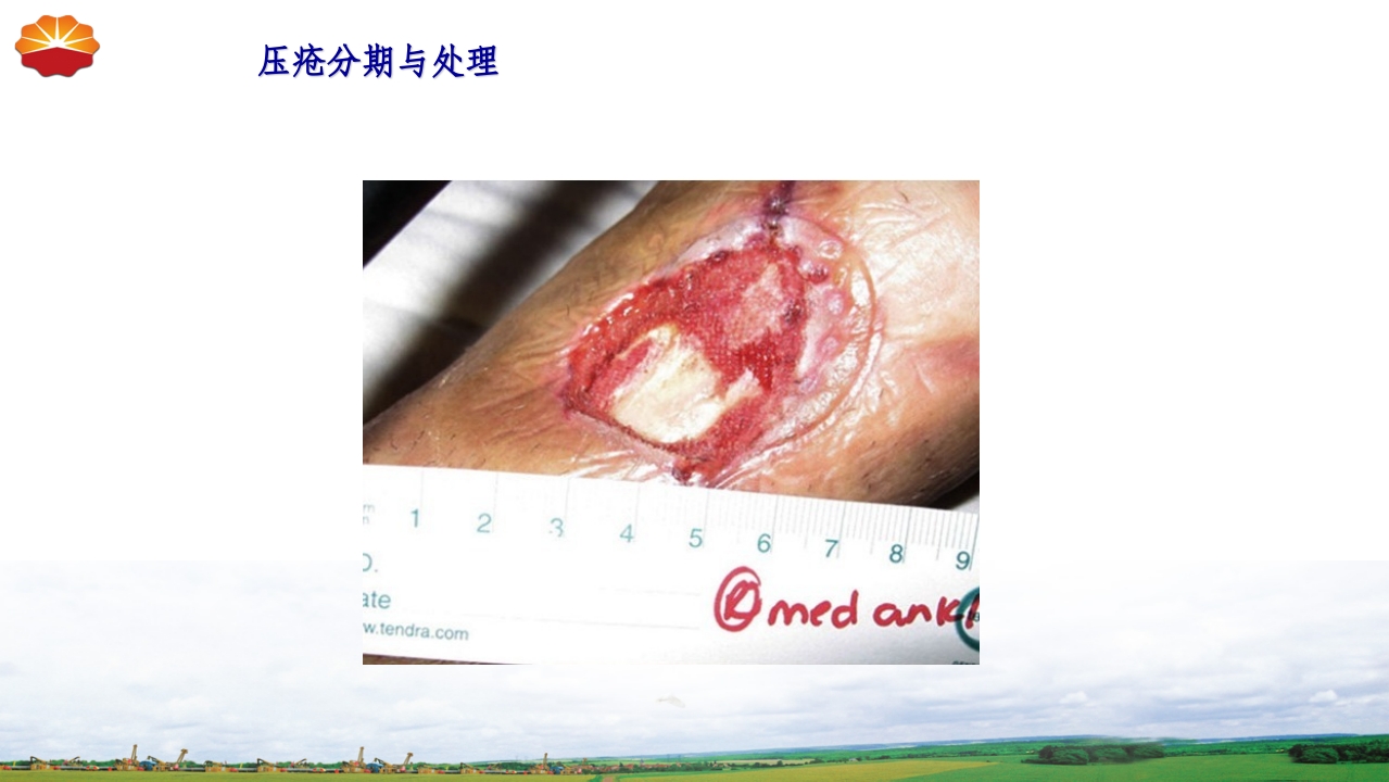 危重患者压疮的治疗及护理27