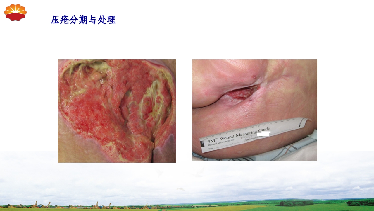 危重患者压疮的治疗及护理31