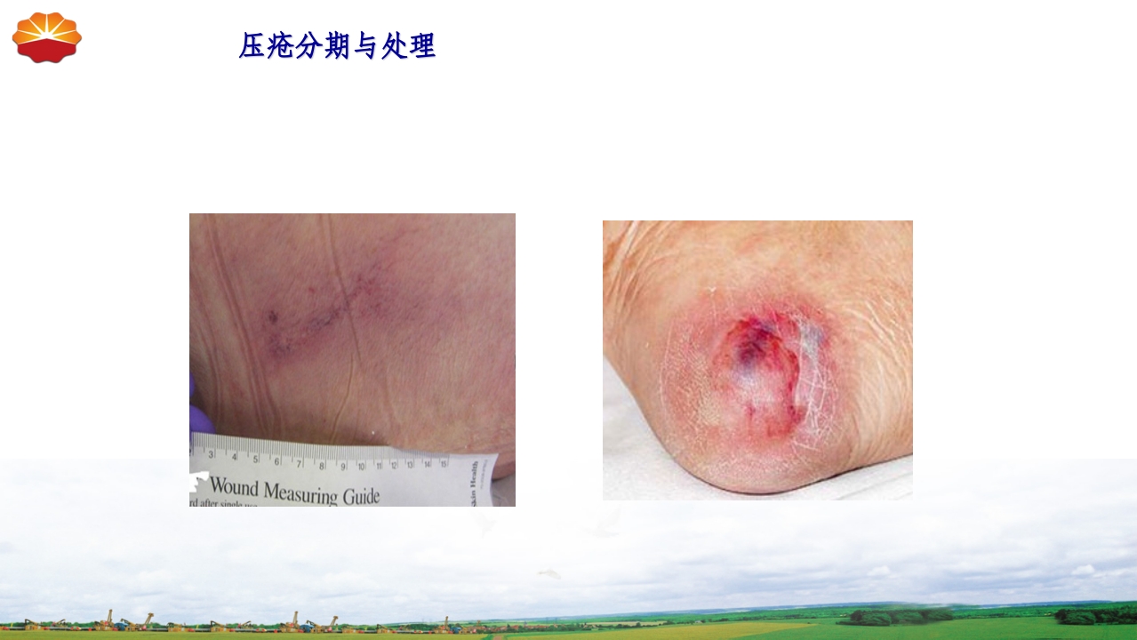 危重患者压疮的治疗及护理34