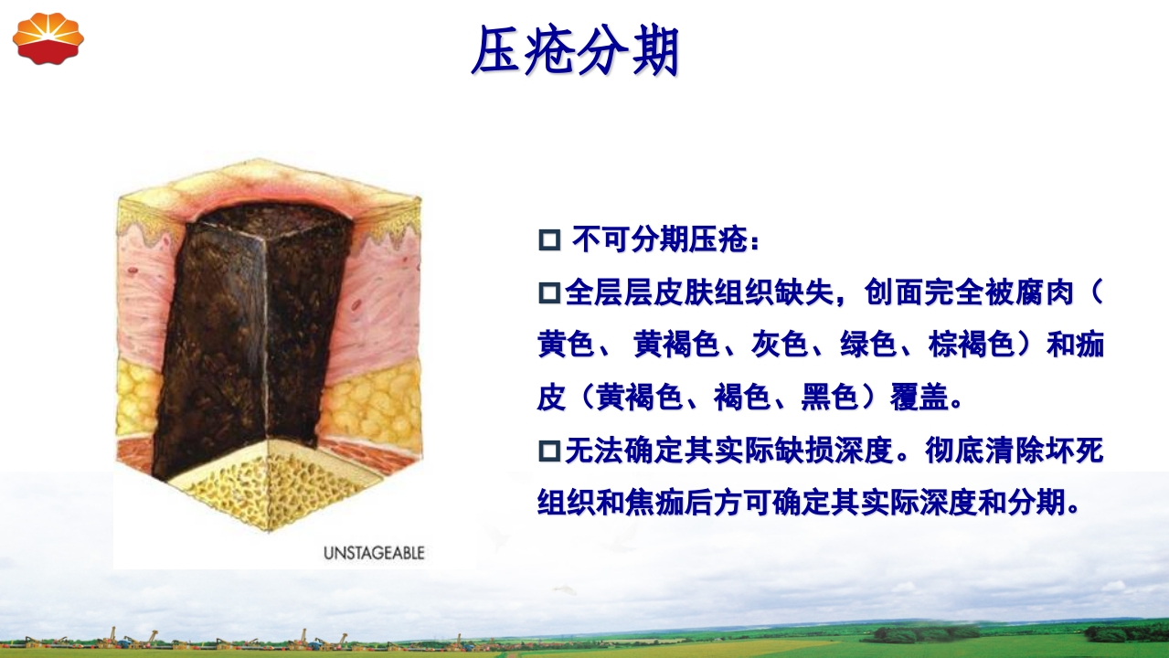 危重患者压疮的治疗及护理35