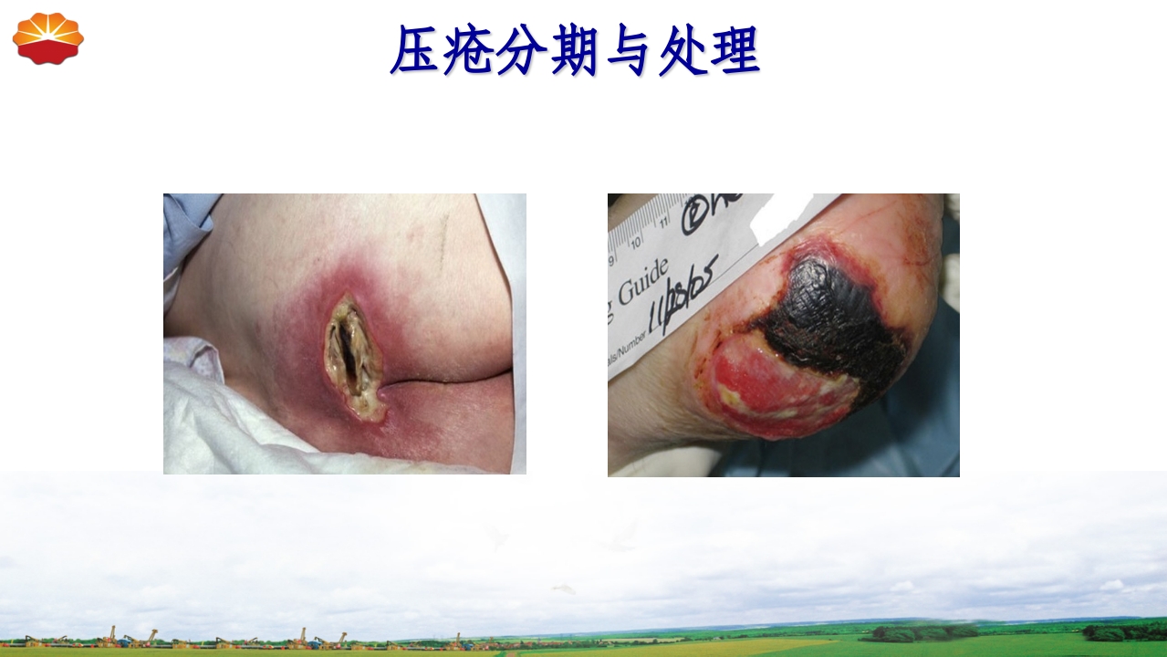 危重患者压疮的治疗及护理37