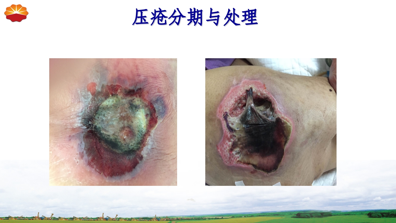 危重患者压疮的治疗及护理38