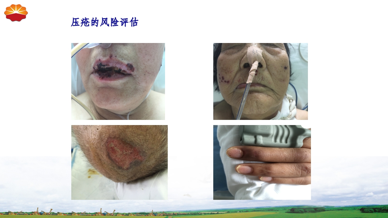 危重患者压疮的治疗及护理52