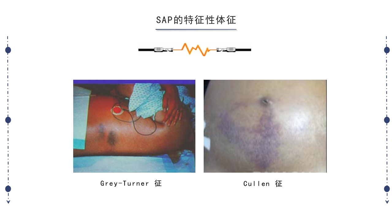 急性胰腺炎护理查房PPT课件下载24