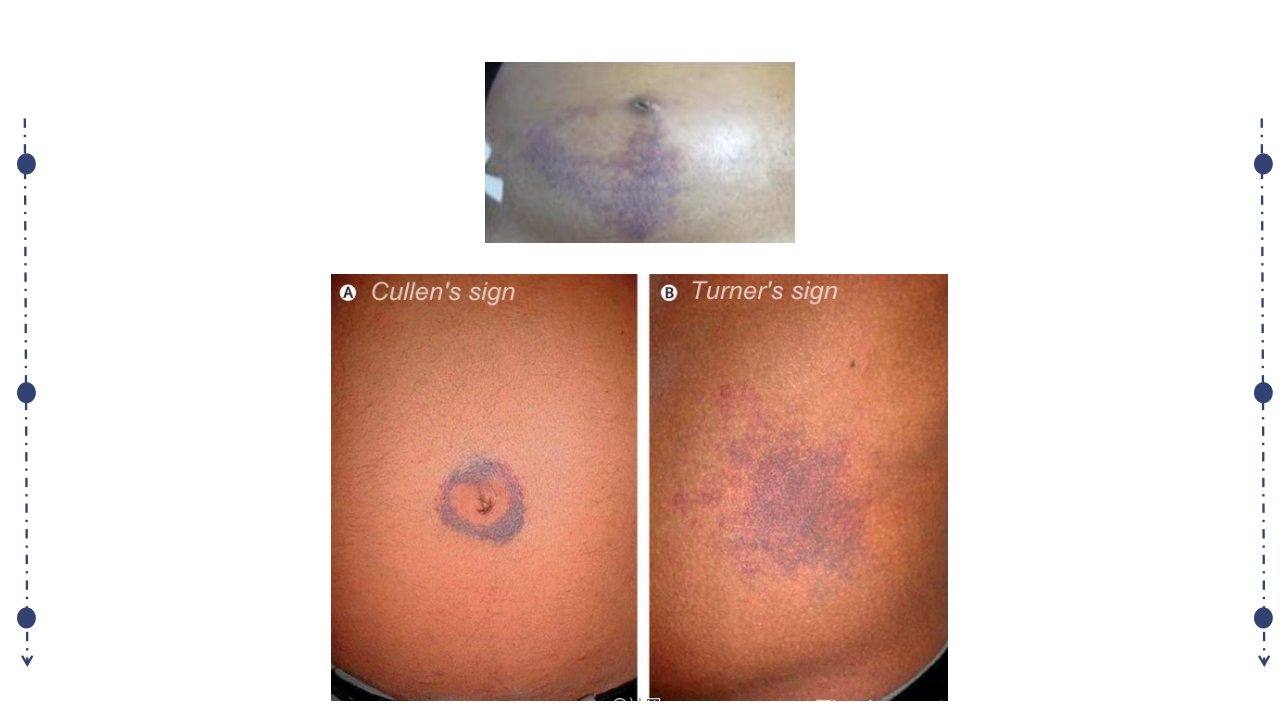 急性胰腺炎护理查房PPT课件下载25