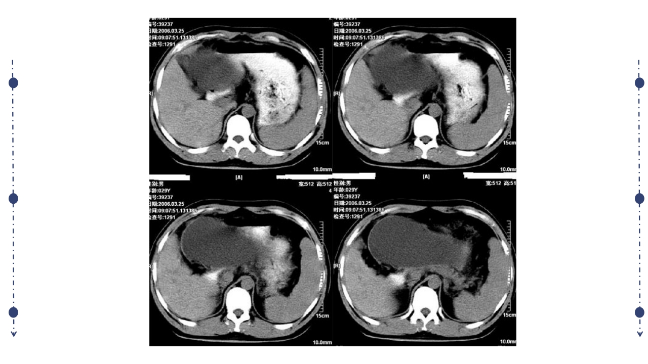 急性胰腺炎护理查房PPT课件下载29
