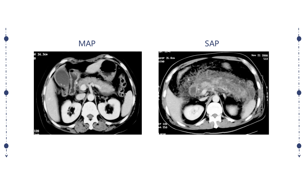 急性胰腺炎护理查房PPT课件下载41