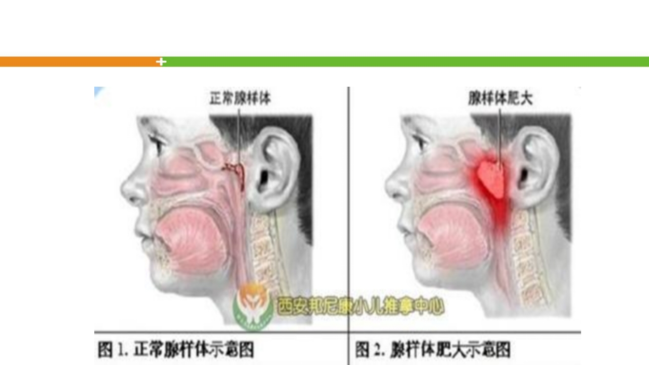 腺样体肥大手术患者的护理ppt课件3