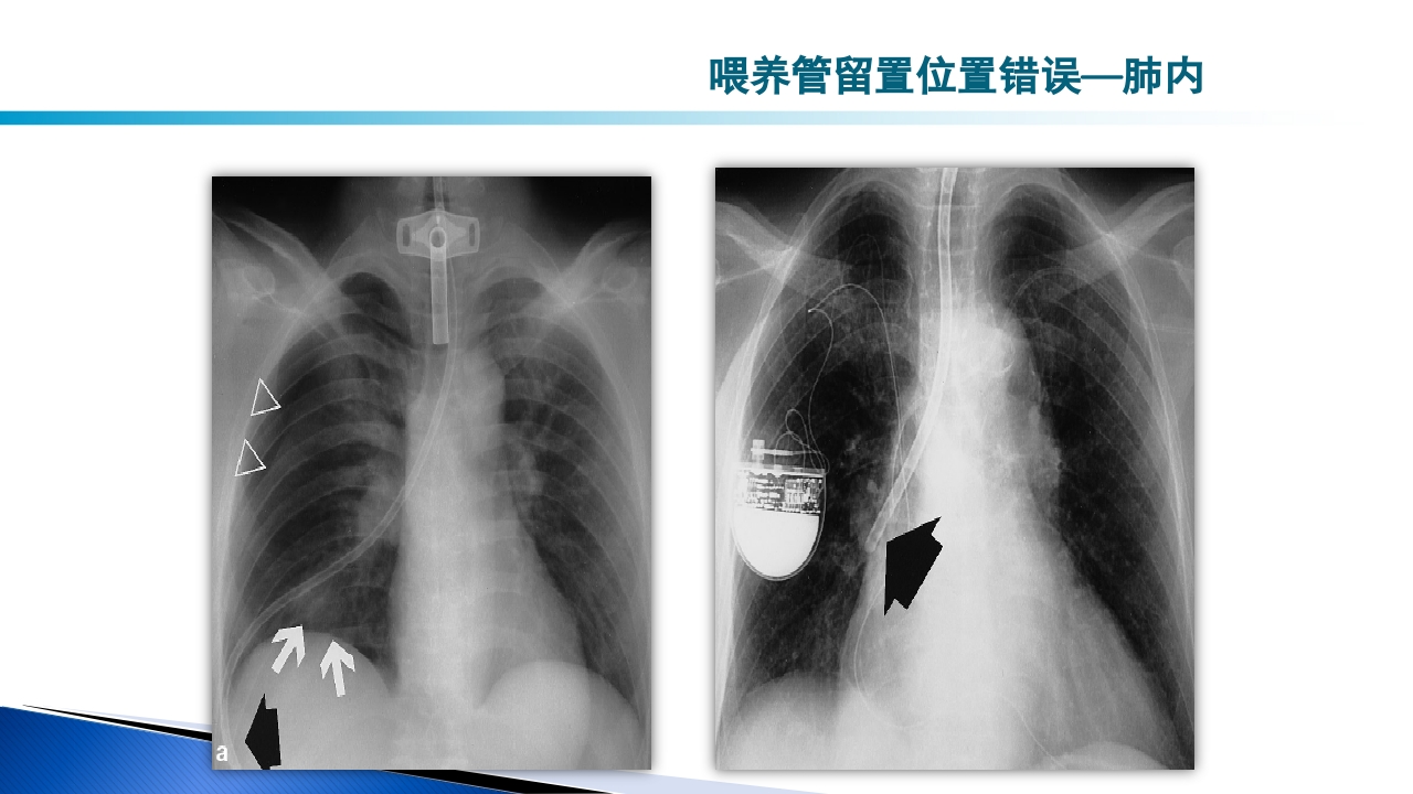 危重病人肠内营养的安全管理PPT课件62