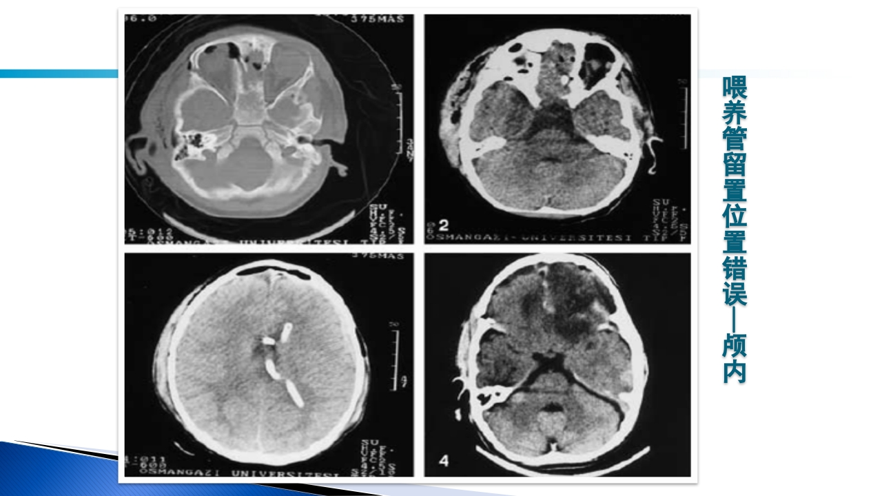 危重病人肠内营养的安全管理PPT课件63