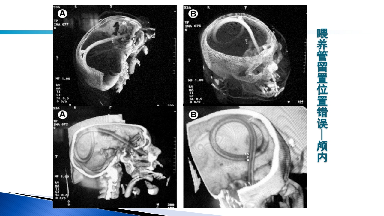 危重病人肠内营养的安全管理PPT课件64