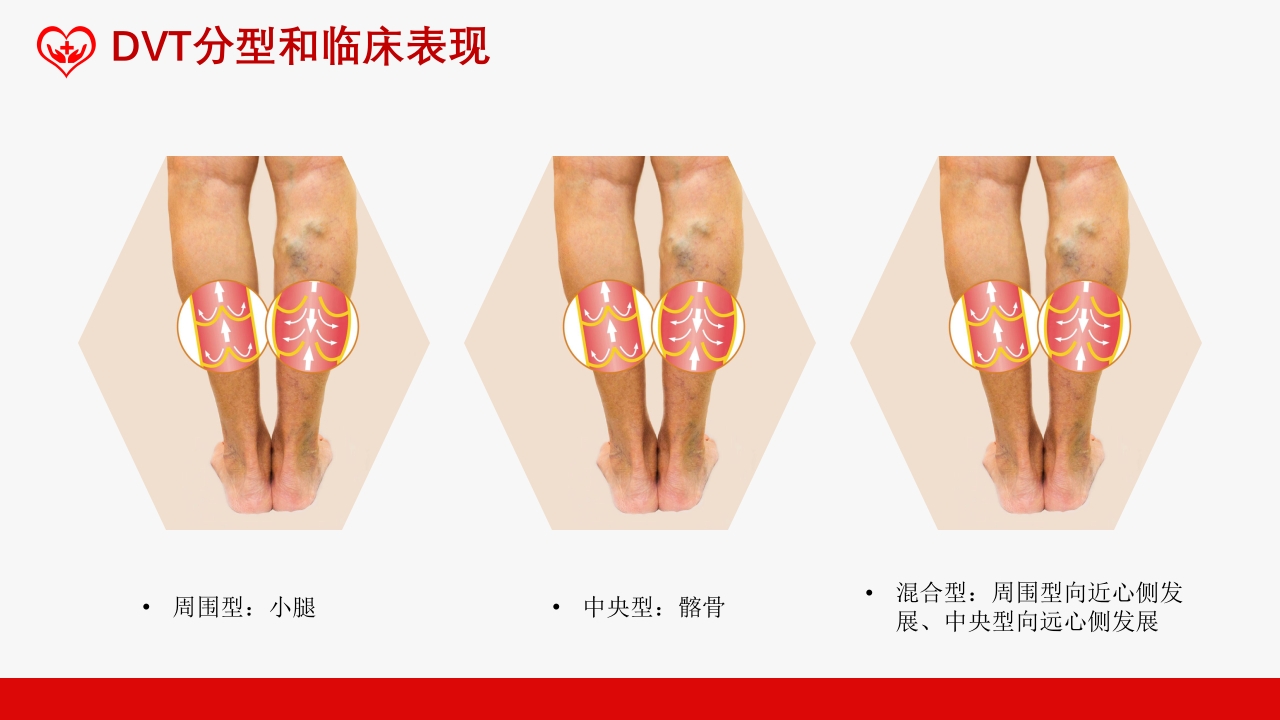 深静脉血栓健康宣教健康PPT课件7