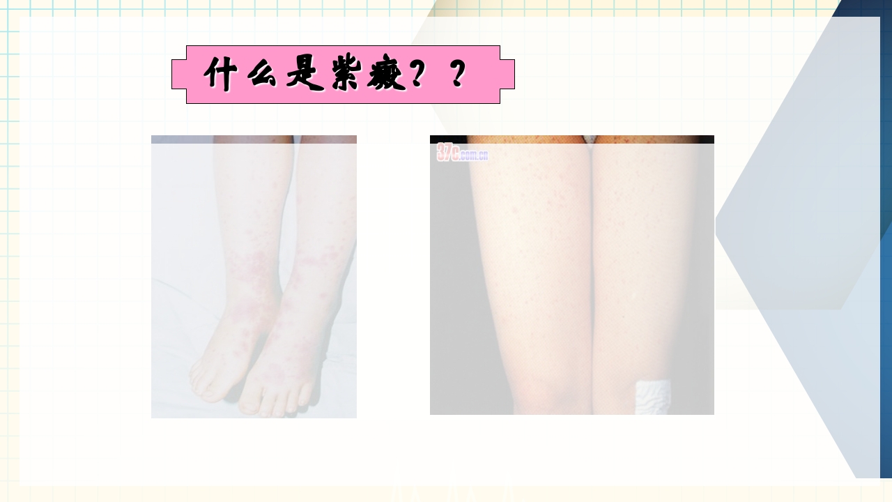 出血性疾病患者的护理PPT课件下载22