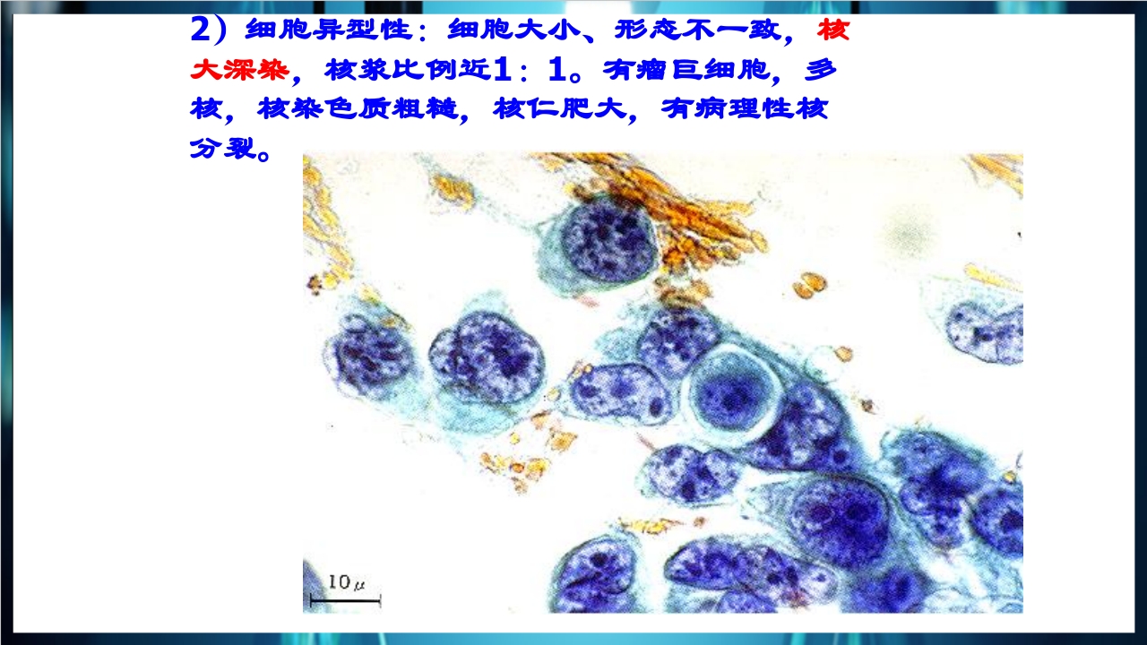 肿瘤病理学简介PPT课件下载13