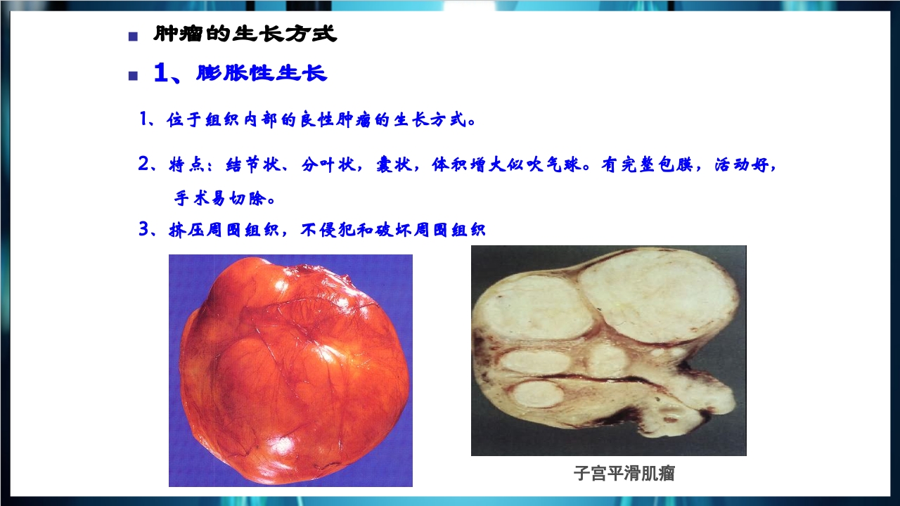 肿瘤病理学简介PPT课件下载16