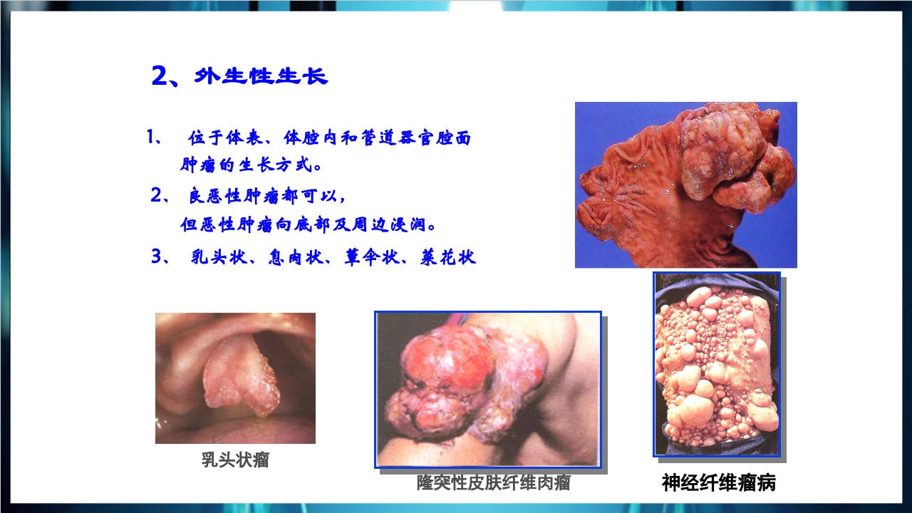 肿瘤病理学简介PPT课件下载17