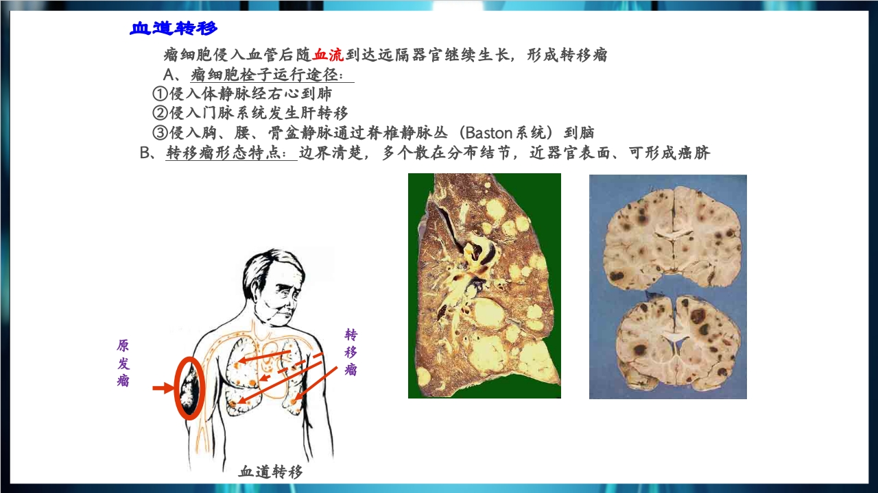 肿瘤病理学简介PPT课件下载21