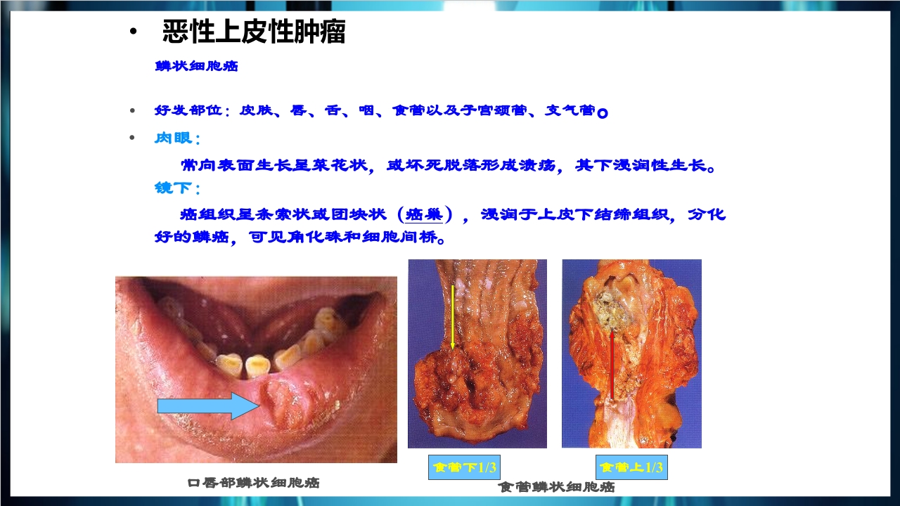 肿瘤病理学简介PPT课件下载29