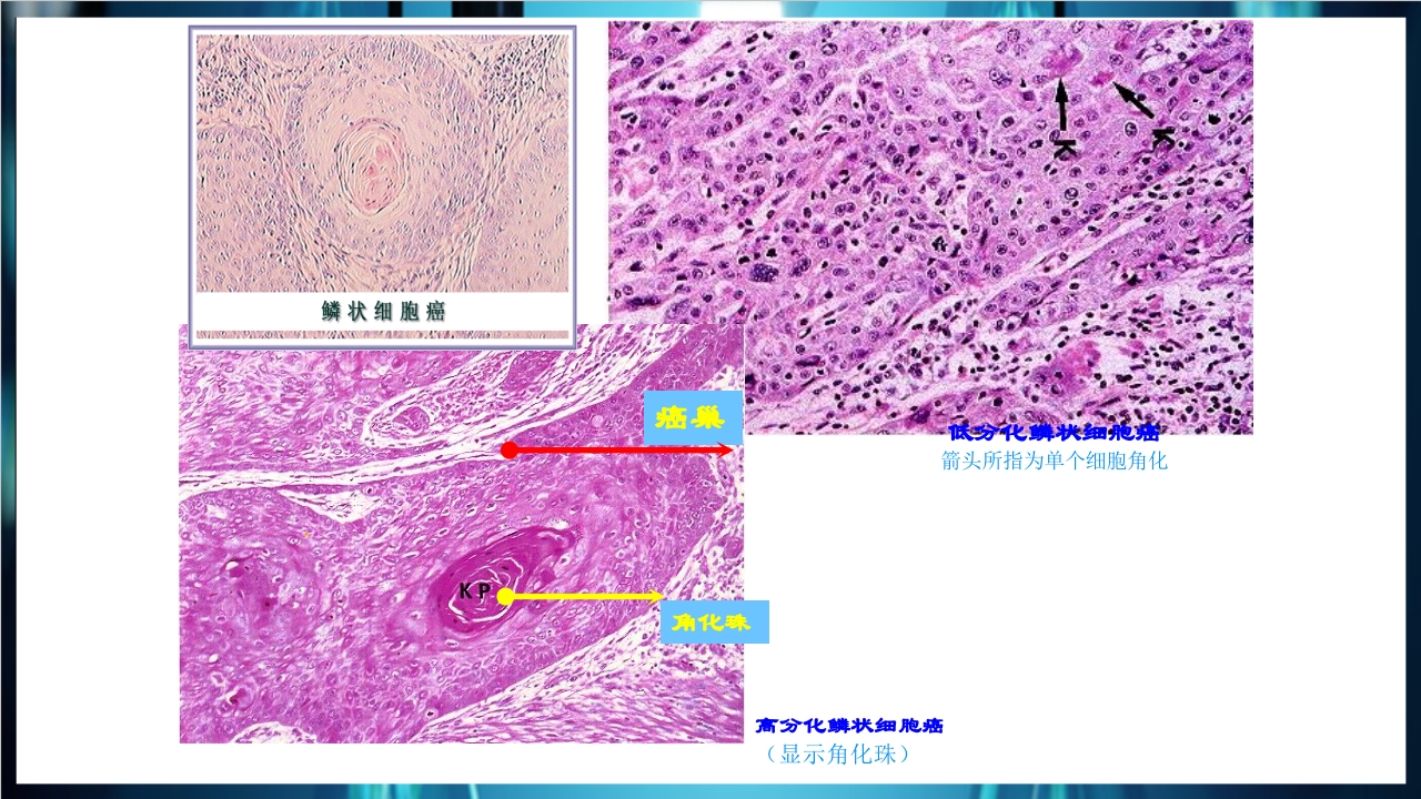 肿瘤病理学简介PPT课件下载30