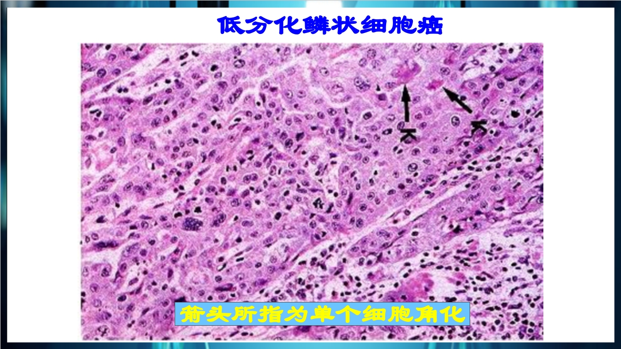 肿瘤病理学简介PPT课件下载31