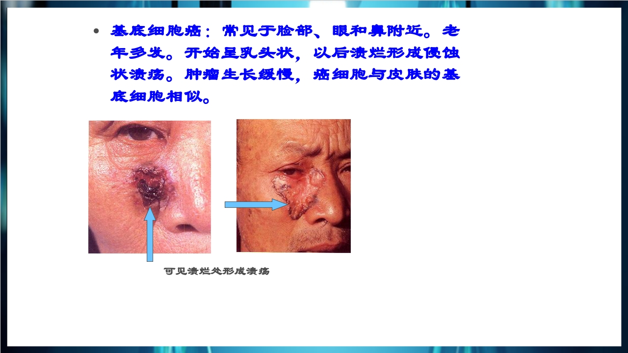 肿瘤病理学简介PPT课件下载32